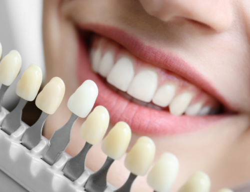 En qué consiste el blanqueamiento dental: consideraciones y pasos